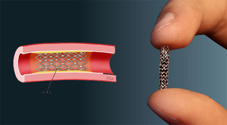 দেশে এখনও হার্টের রিংয়ের দাম তুলনামূলক বেশি