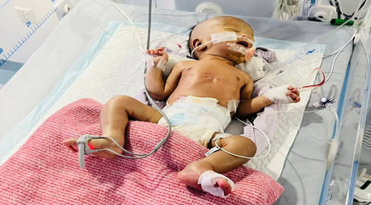 জন্মের পরই বেঁচে থাকার লড়াই, সঙ্গী একদল চিকিৎসক