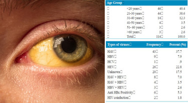 জন্ডিস আক্রান্ত হওয়ার প্রধান কারণ হেপাটাইটিস ‘এ’ ও ‘ই’ ভাইরাস