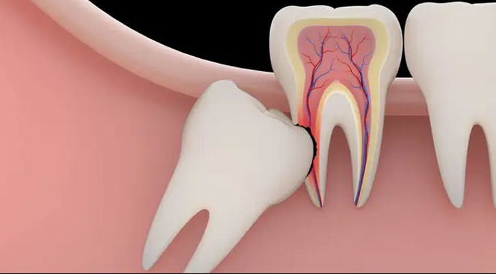 আক্কেলদাঁত ফেলে দিলে কোনো ক্ষতি হয়?