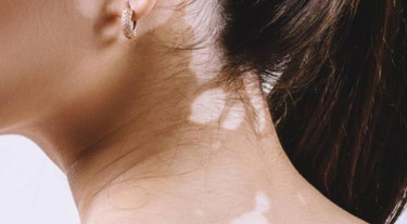 শিশুর ত্বকে সাদা বা ফ্যাকাশে দাগ?